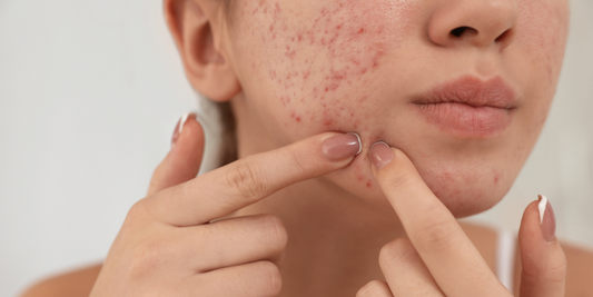 Targeted & Trauma-Free: Your Guide to Advanced Needleless Acne Solutions