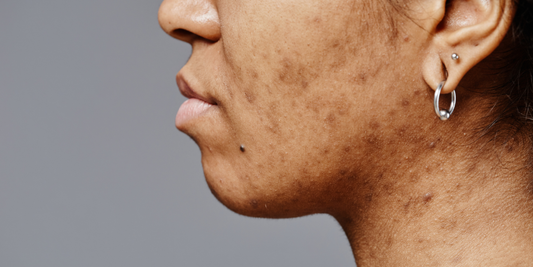 The Clear Skin Comeback