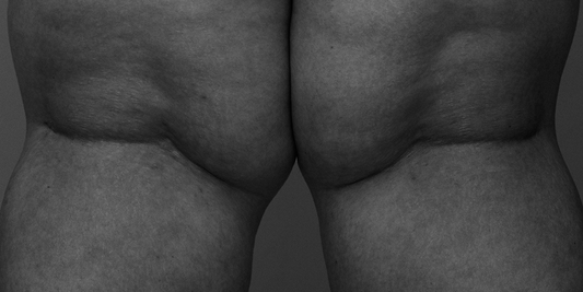 Unlocking Your Ideal Shape: The Pain-Free Science of Needle-Free Body Contouring