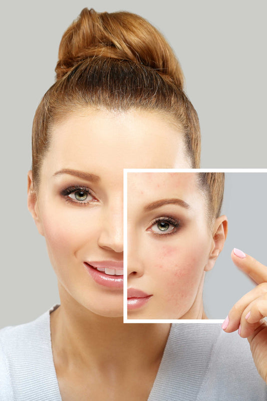 Acne Injections