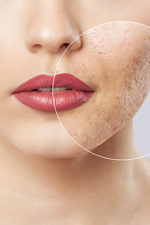 Acne Scarring Injections