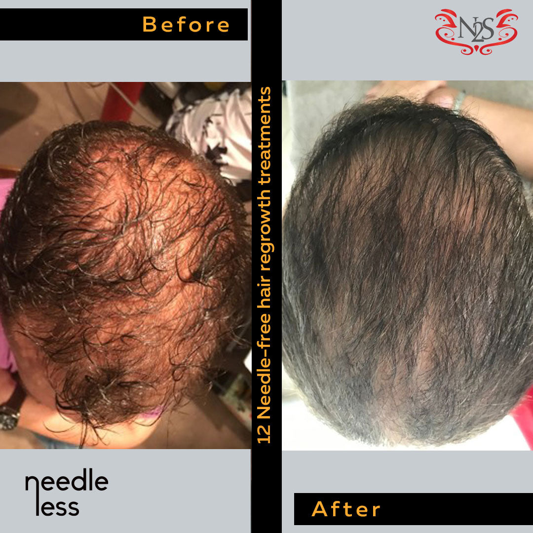 Update more than 123 zinc hair loss regrowth super hot camera.edu.vn